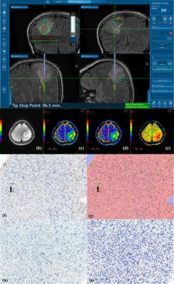 Multi-b-value diffusion stretched-exponential model parameters correlate with MIB-1 and CD34 expression in Glioma patients, an intraoperative MR-navigated, biopsy-based histopathologic study